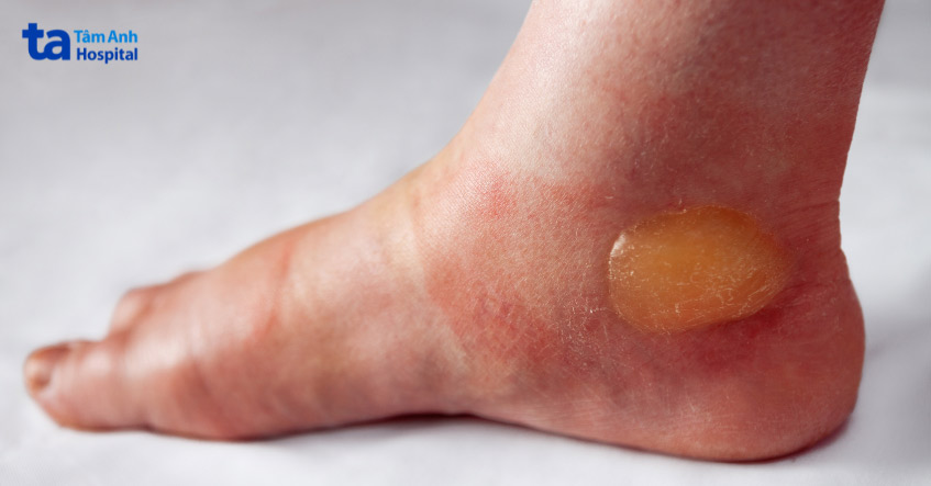 Pemphigoid gây bóng nước dưới lớp thượng bì