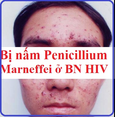 tổn thương da do nhiễm nấm Penicillium marneffei
