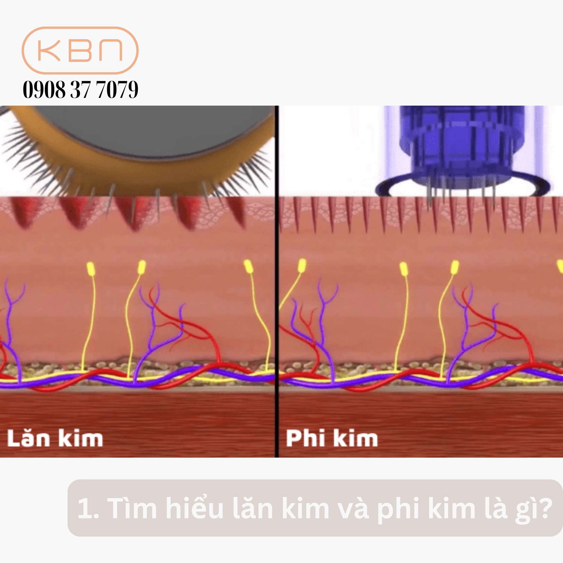 Phân biệt phi kim và lăn kim
