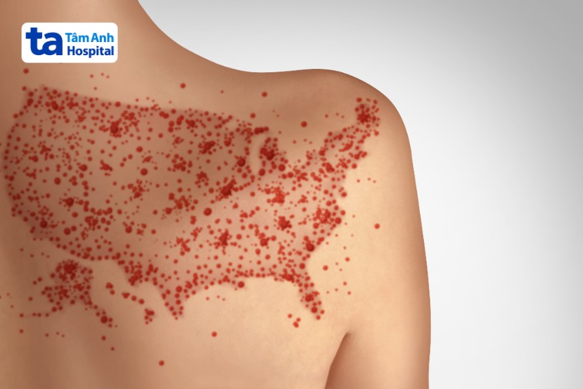 Phát ban là dấu hiệu của nhiễm trùng huyết