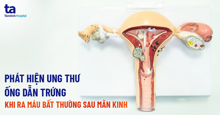 Phát hiện ung thư ống dẫn trứng