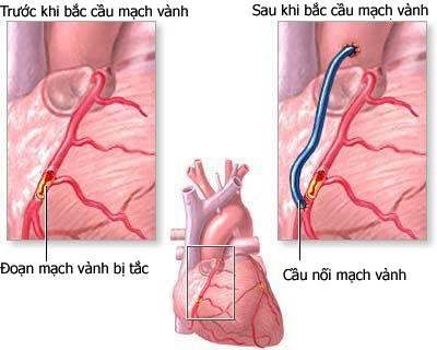 Phẫu thuật bắc cầu động mạch vành