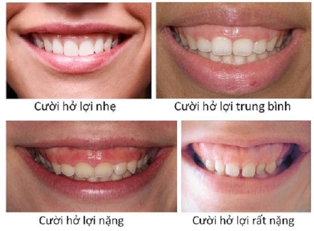 Phẫu thuật điều trị cười hở lợi
