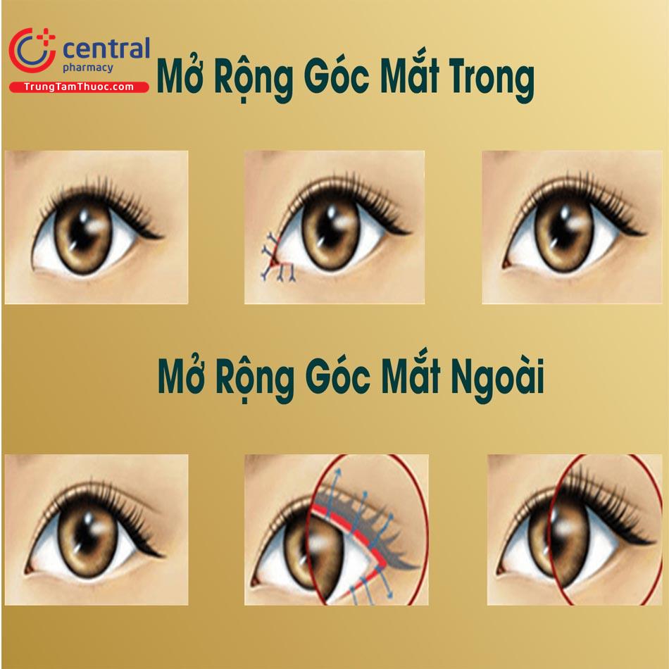 Phẫu thuật mở rộng góc mắt trong và ngoài