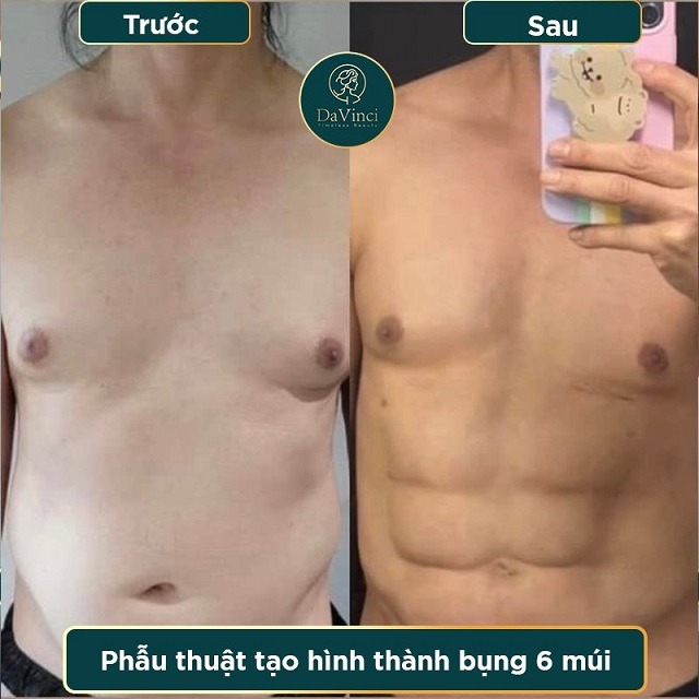 Phẫu thuật tạo cơ bụng nam giới