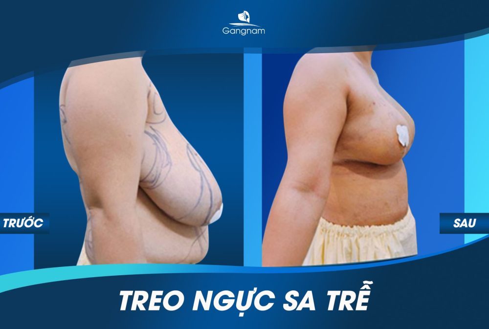 Phẫu thuật treo ngực sa trễ