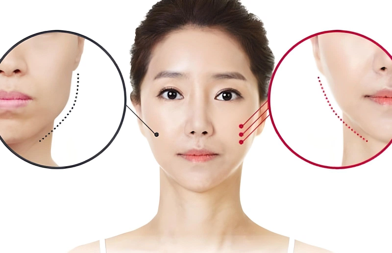 Phẫu thuật gọt hàm V-line