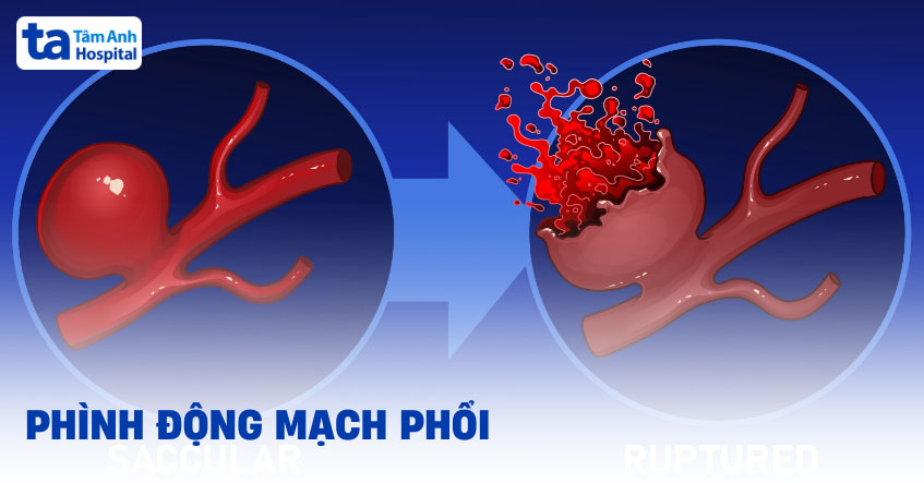 CT phình động mạch phổi