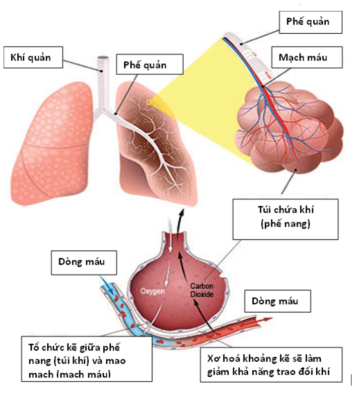 Viêm phổi tổ chức hóa: Nguyên nhân, triệu chứng và cách điều trị hiệu quả 8 Ảnh chụp CT viêm phổi tổ chức hóa