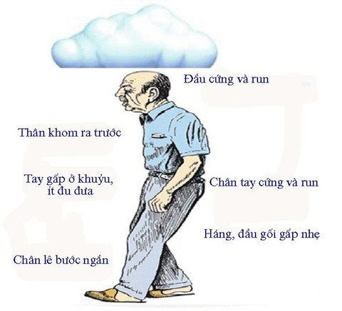 Run tay khi cố gắng cầm ly nước
