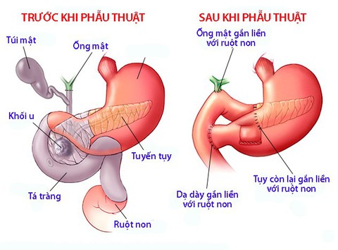 Ban đỏ hoại tử trong glucagonoma