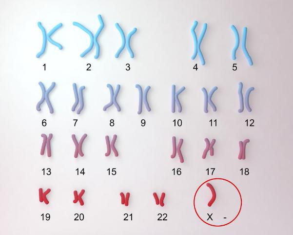 Hội chứng Down do bất thường nhiễm sắc thể