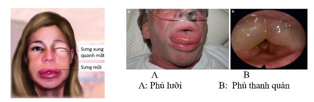 phu-mach-mac-phai-la-gi