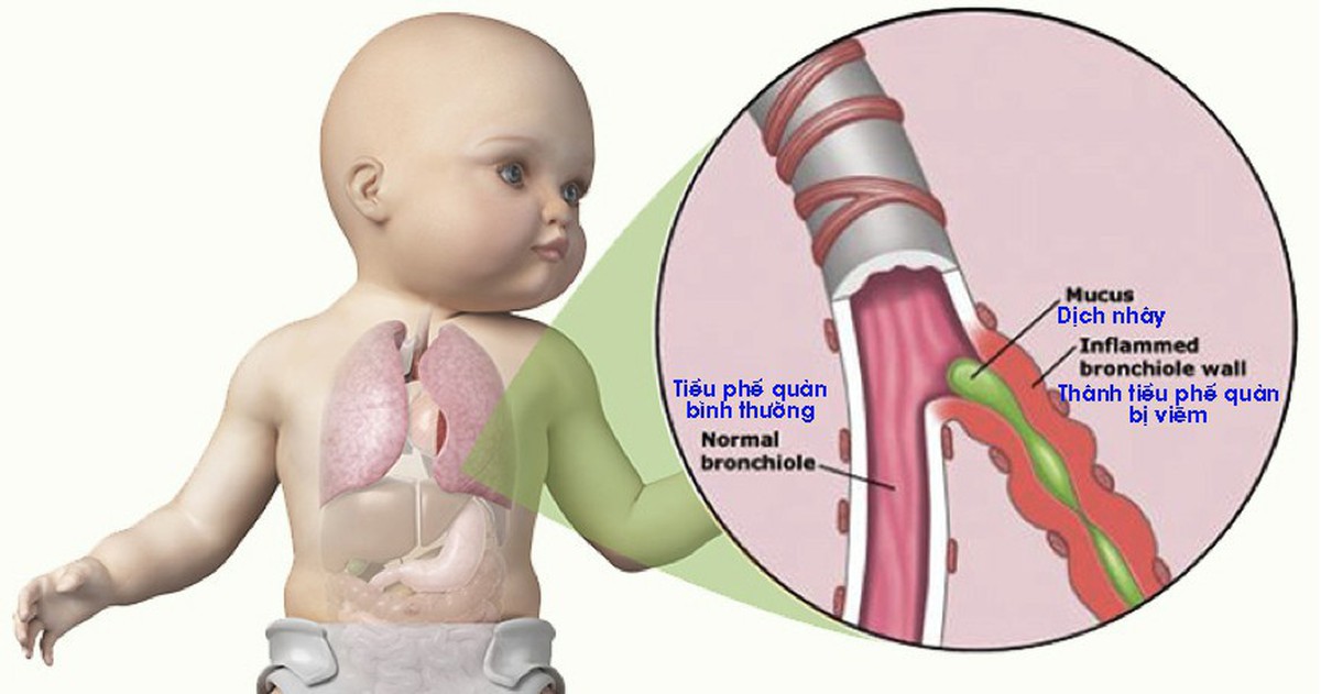 Triệu chứng viêm tiểu phế quản tắc nghẽn ở trẻ nhỏ
