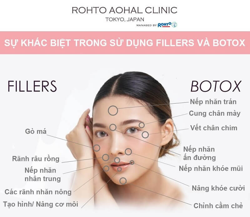 Tiêm Botox vùng mắt