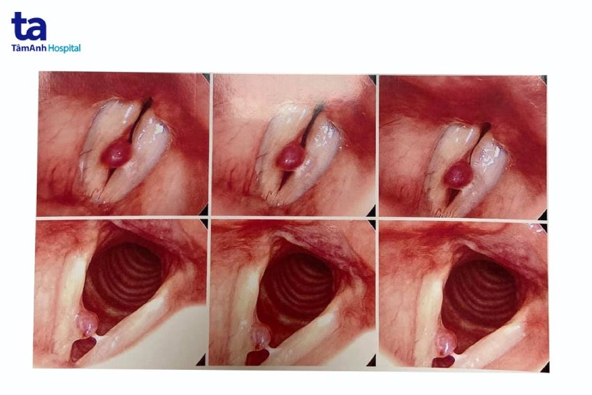Đối tượng dễ mắc polyp dây thanh