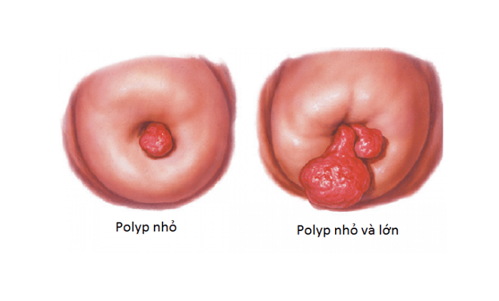 Polyp cổ tử cung là gì?