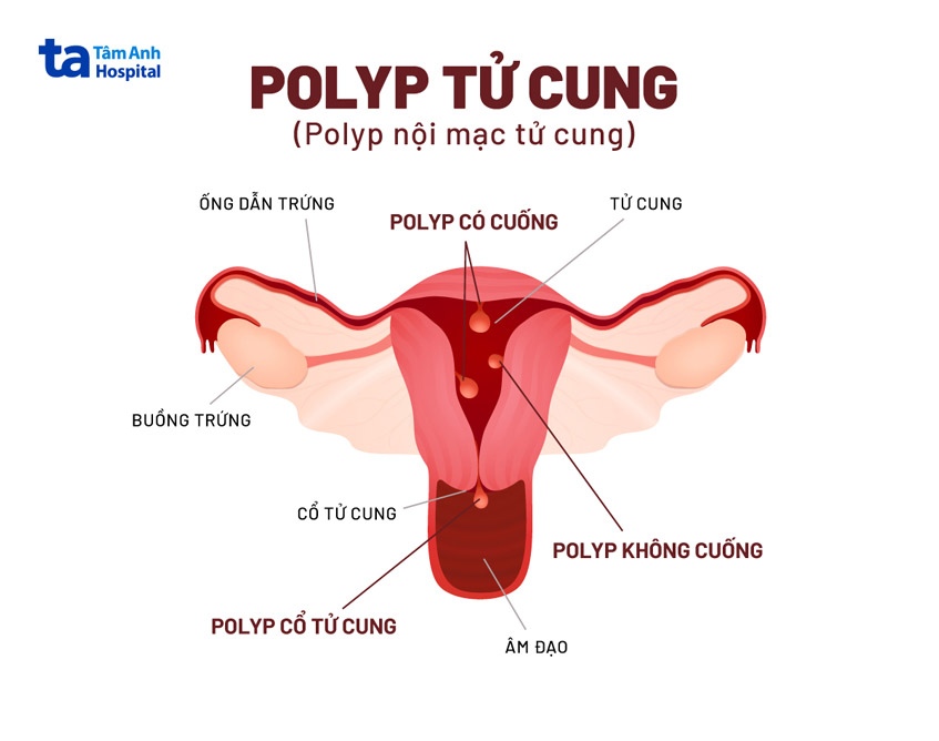 Điều trị polyp cổ tử cung bằng ngoại khoa