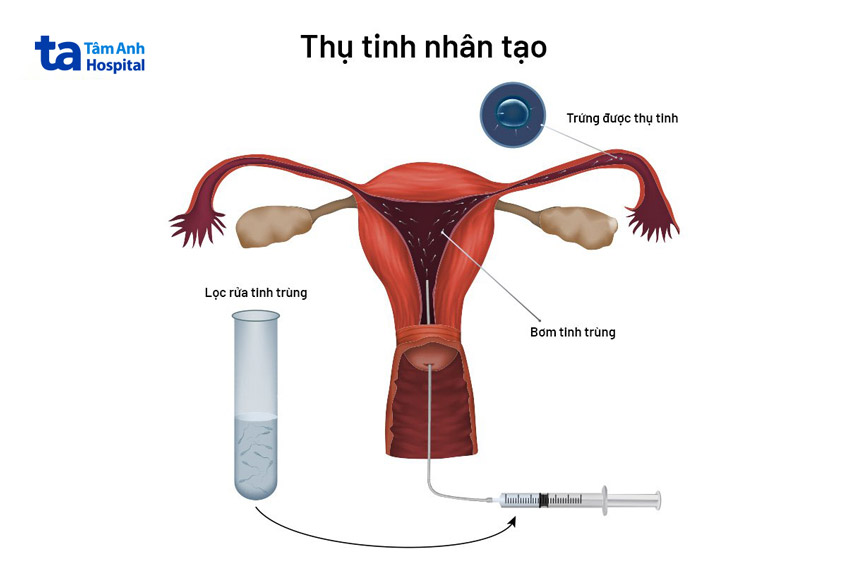 Quá trình bơm tinh trùng vào tử cung