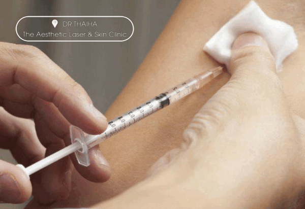 Quy trình tiêm corticoid trị sẹo