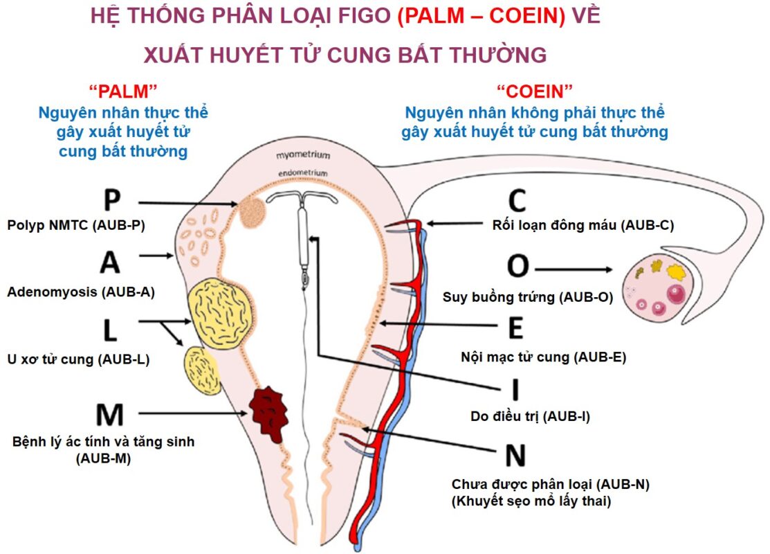 Chẩn đoán nguyên nhân chảy máu tử cung thực thể