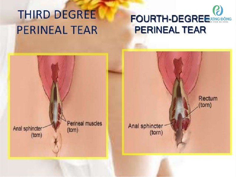 Nhiễm trùng tầng sinh môn sau sinh