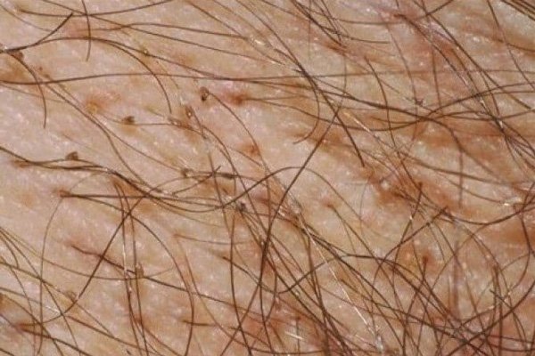 Cách điều trị rận mu
