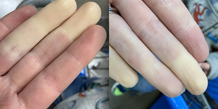Hiện tượng Raynaud (đầu ngón tay trắng bệch, tím tái khi gặp lạnh) 7 Hiện tượng Raynaud