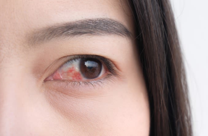 Mắt đỏ viêm kết mạc