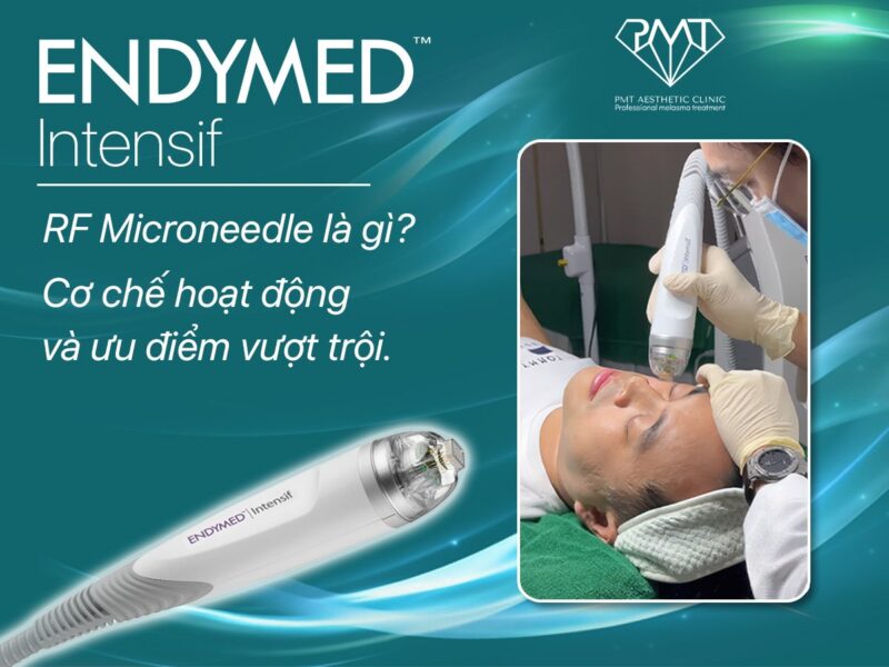 RF vi điểm là gì