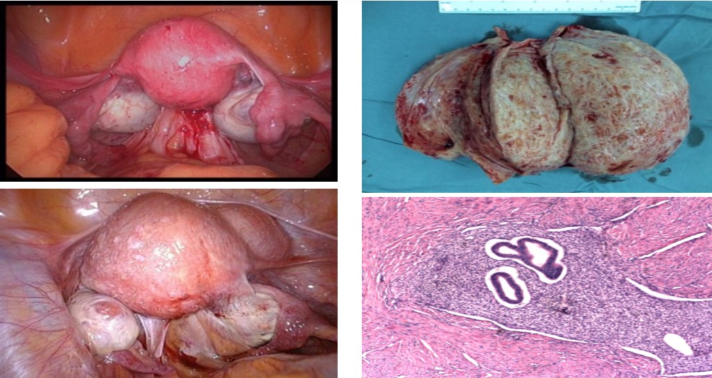 Phương pháp RFA điều trị adenomyosis