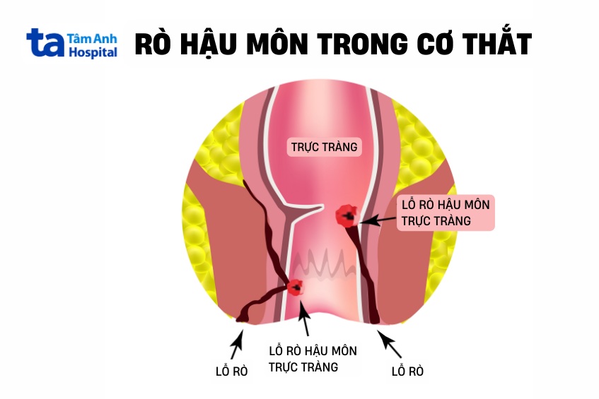 rách cơ thắt hậu môn khi sinh
