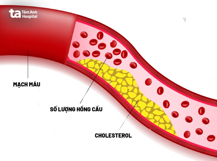 Rối loạn mỡ máu là gì