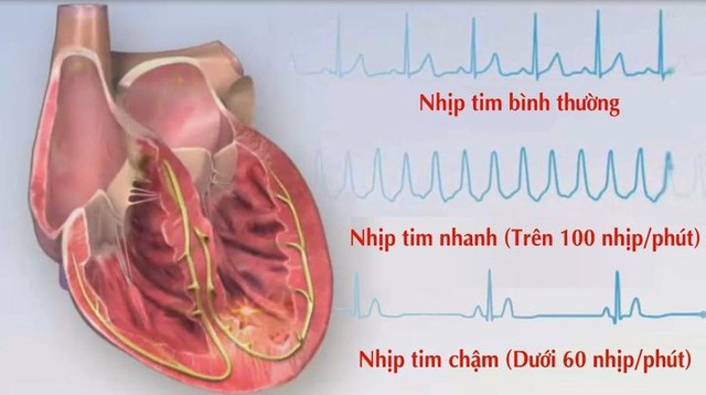 Nguyên nhân gây rối loạn nhịp tim