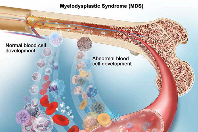 Hội chứng rối loạn sinh tủy MDS