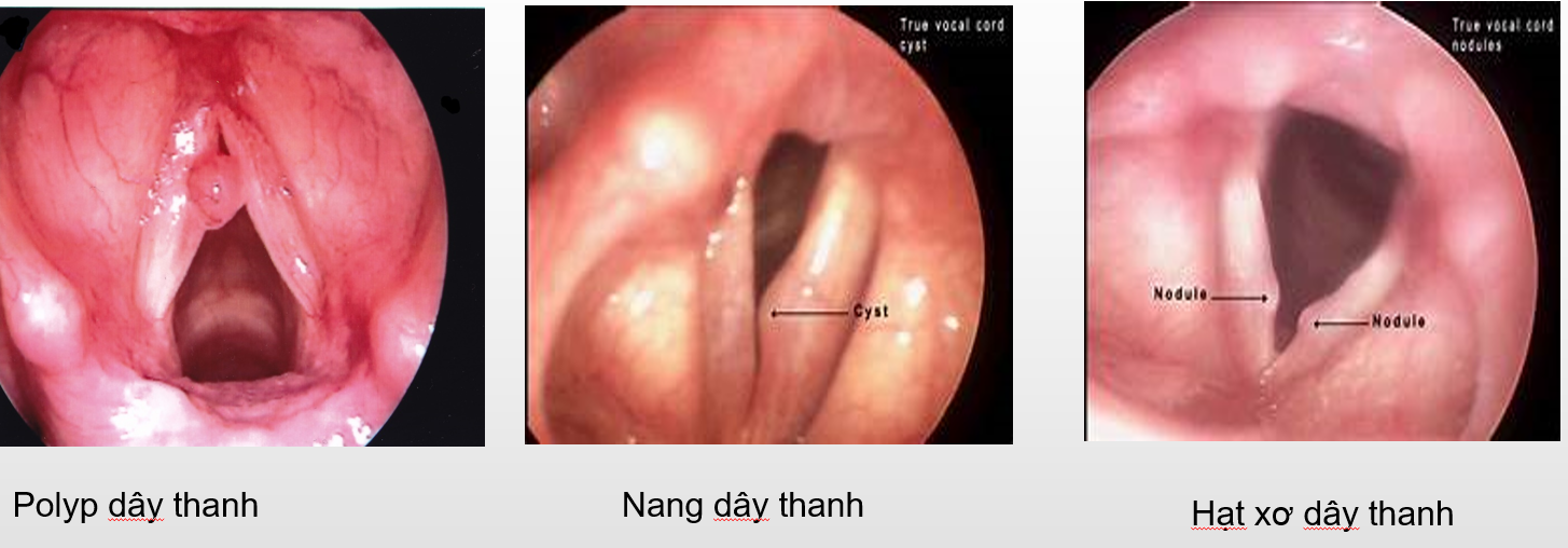 Nội soi dây thanh âm
