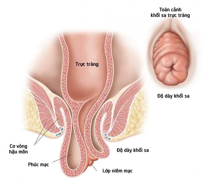 Triệu chứng sa trực tràng