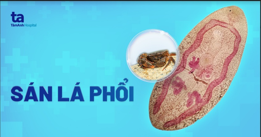 nhiễm sán lá phổi
