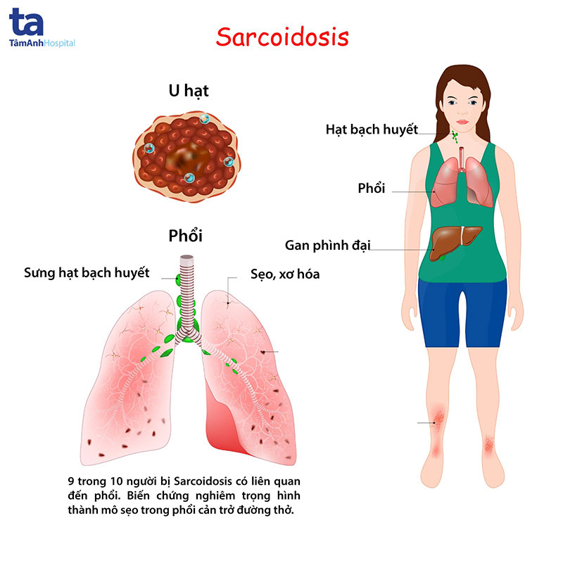 Hình ảnh mô phỏng tổn thương tim do amyloidosis