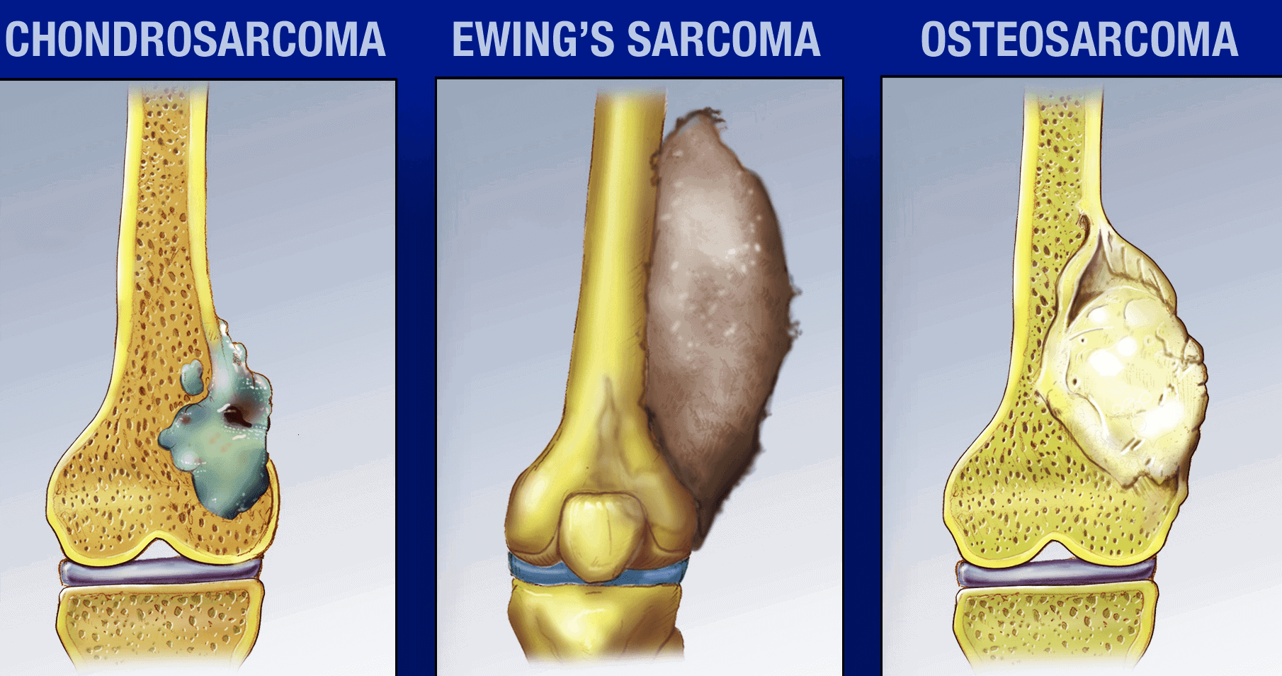Hình ảnh mô phỏng sarcoma sụn