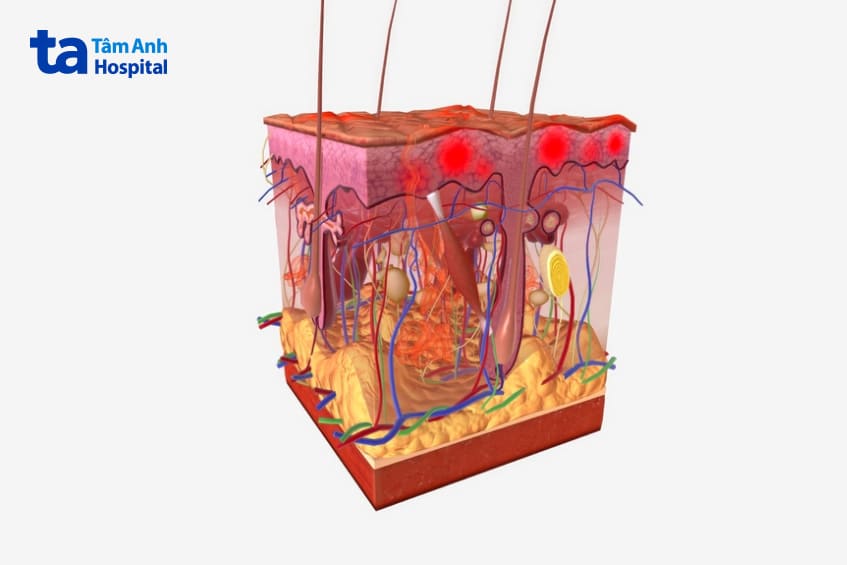 Điều trị sarcoma sợi