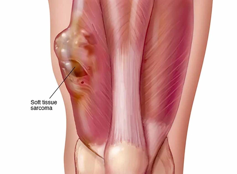 Sarcoma cơ vân ở trẻ em