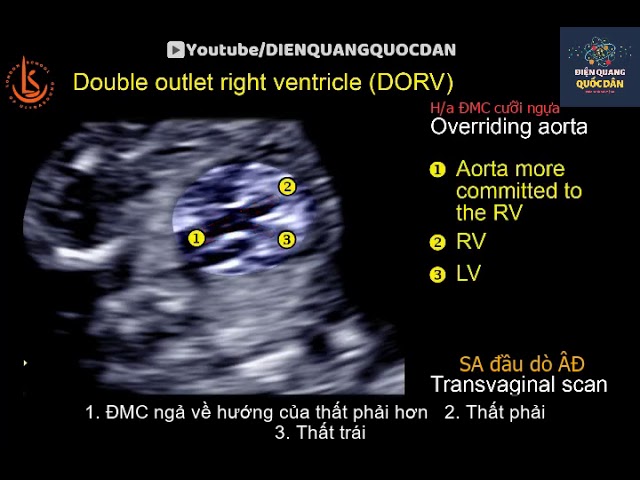 Cấu trúc tim trong bệnh DORV