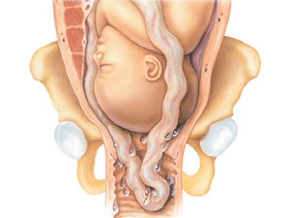 Hình ảnh sa dây rốn qua âm đạo