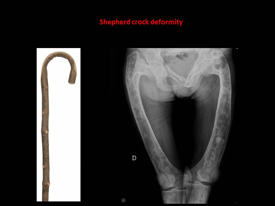 biến dạng xương shepherd's crook