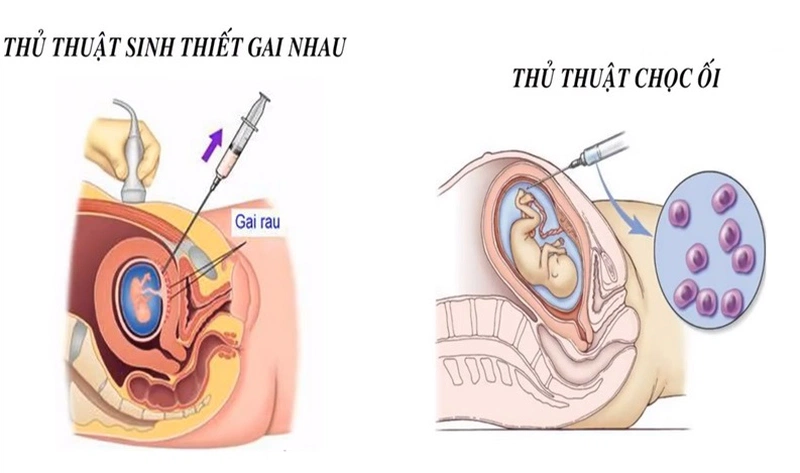 Hình ảnh minh họa sinh thiết gai nhau