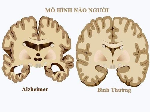 Hình ảnh não người bệnh Alzheimer
