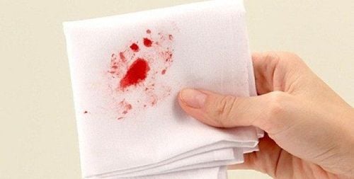 Chụp X-quang phổi bệnh nhân ho ra máu