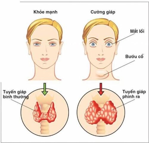 Cường giáp thai kỳ