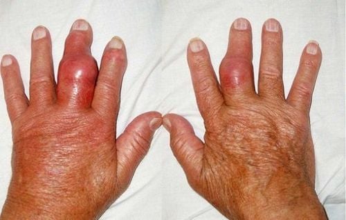 Nguyên nhân viêm đa khớp đối xứng